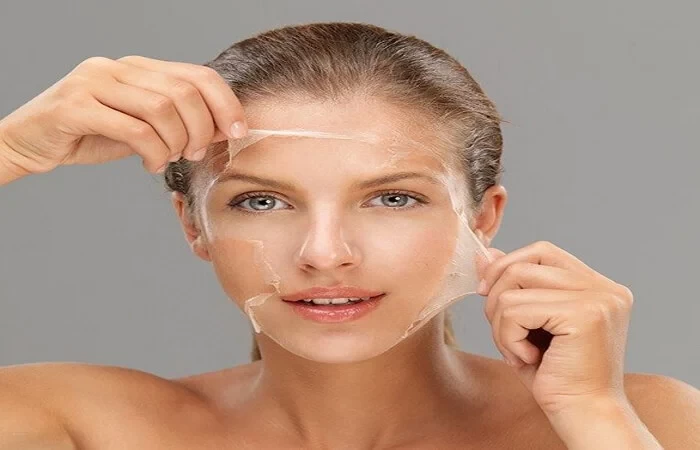 تقشير كيميائي للبشره image